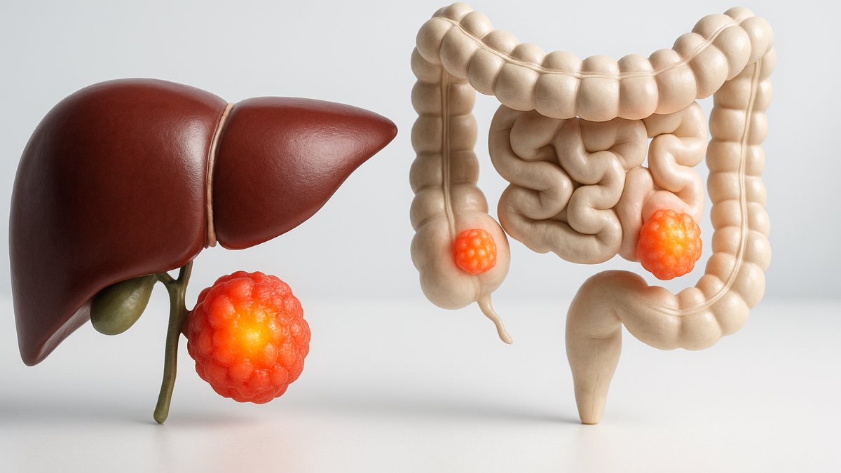 Incidence of Colorectal Cancer in Iran: A Systematic Review and Meta‑Analysis