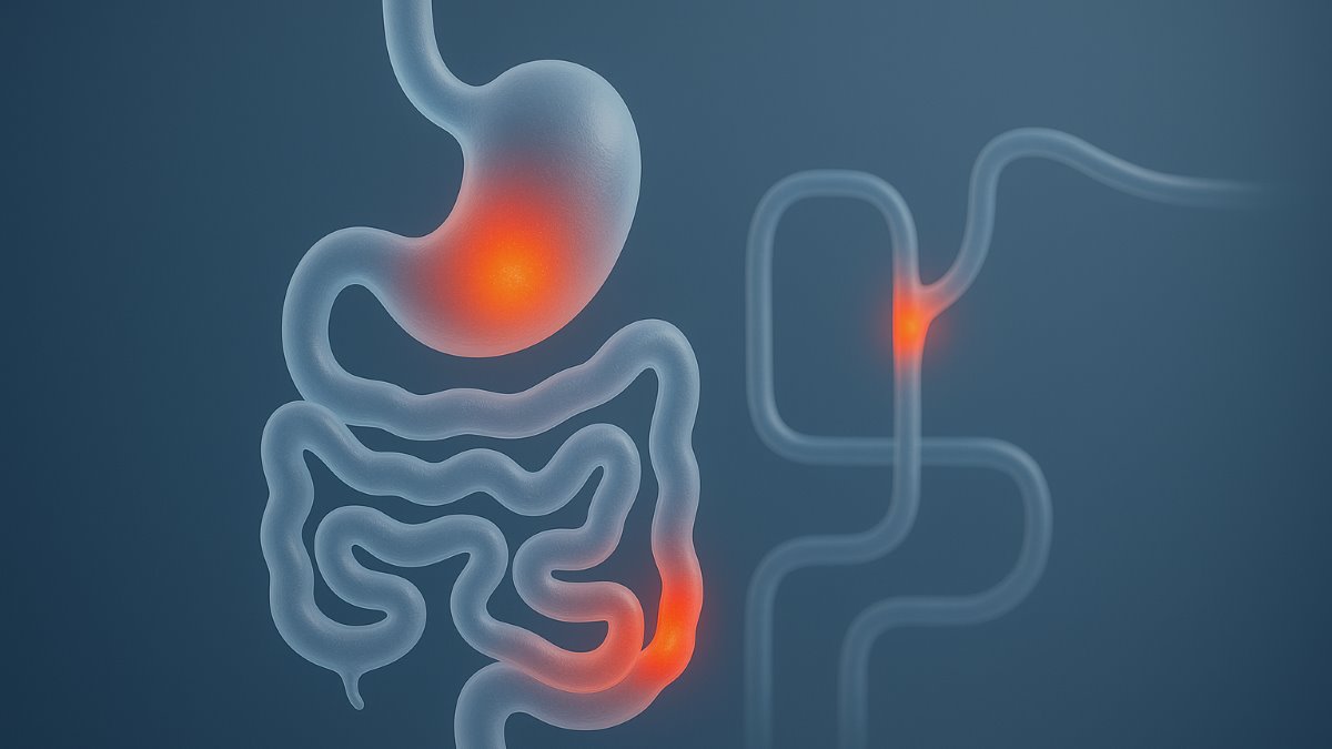 Methylation and Polymorphism in Cdh1 Gene Promoter Among Patients With Diffuse Gastric Cancer