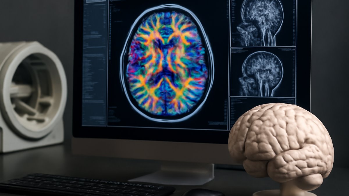 Adherence to the Dietary Approaches to Stop Hypertension-Style Diet in Relation to Glioma: A Case-Control Study