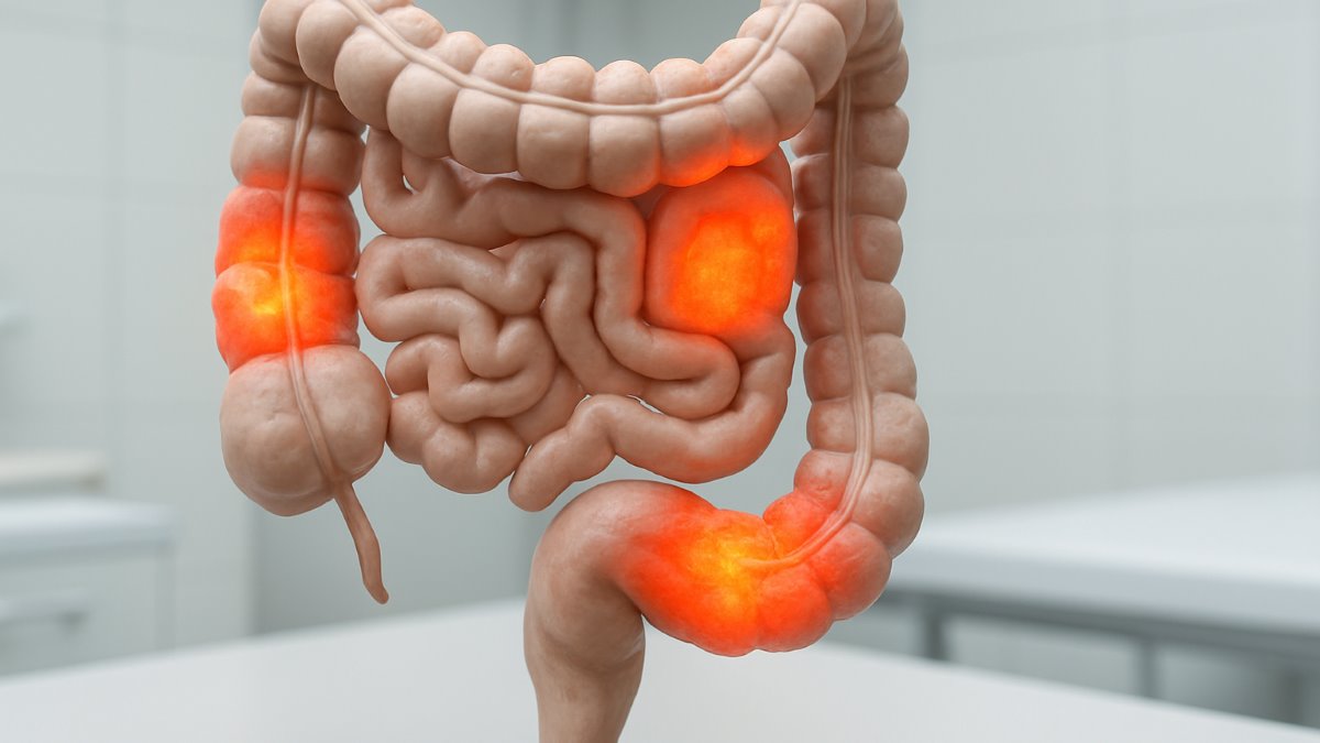 Clostridium Difficile Infection in Cancer Patients With Hospital Acquired Diarrhea at the Teaching Hospitals in Iran: Multilocus Sequence Typing Analysis (Mlst) and Antimicrobial Resistance Pattern